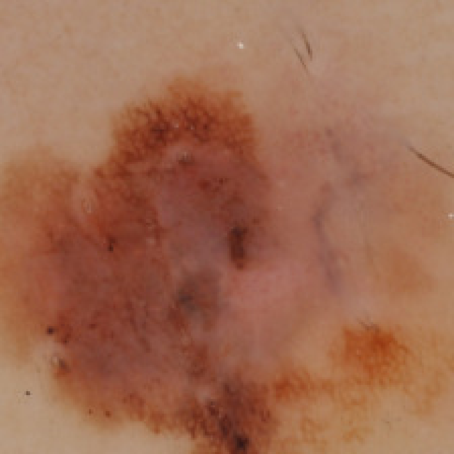 Skin Lesion